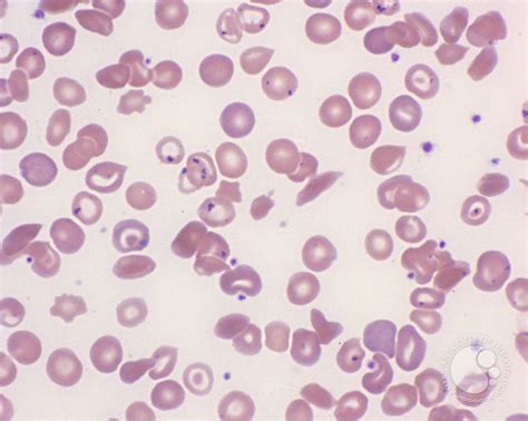 Pappenheimer Bodies in Sickle Cell Disease - 2.