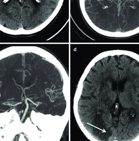 Posterior Cerebral Artery Occlusion