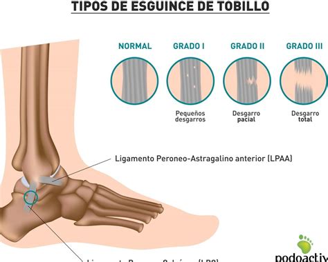 Tiempo De Baja Por Esguince De Tobillo Grado Cu Nto Dura