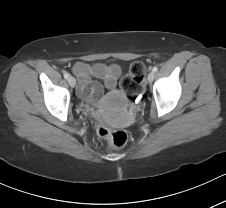 Tubal Ligation Clips Image Radiopaedia Org