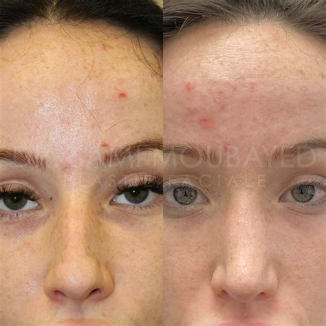 Rhinoplastie Ultrasonique Montr Al Clinique Face Md Rhinoplastie