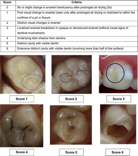 Icdas Caries Classification