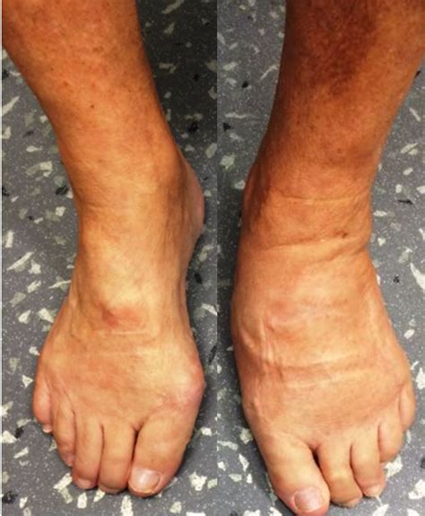 Top 99 Pictures Pictures Of Cellulitis On Foot Latest