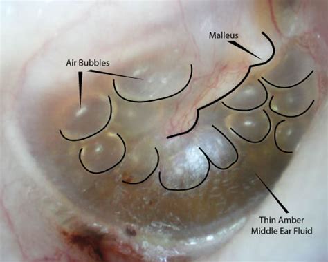 Fluid Behind Ear Not Draining - Best Drain Photos Primagem.Org