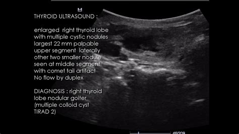 Case Right Thyroid Lobe Nodular Goiter Multiple Colloid Cyst Tirad