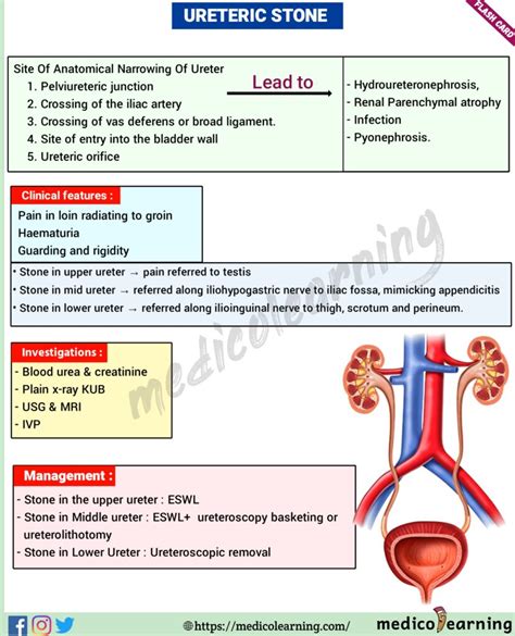 Ureteric Stone – MedicoLearning