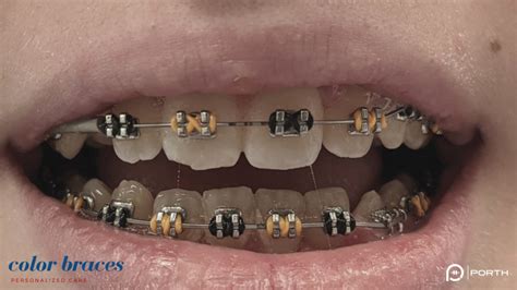 Colored Braces Modern Orthodontics Clinic