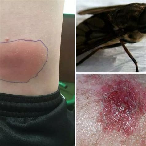 Horse Fly Bite