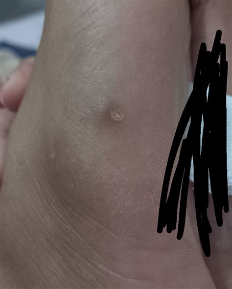 Painful Bump on my foot : r/DermatologyQuestions