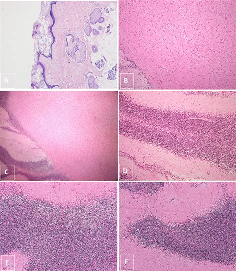 A Hematoxylin And Eosin Stained Sections Showing Skin Along With Skin