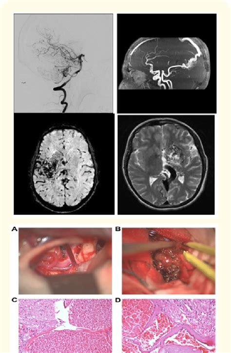 Intraoperative imaging and pathological images [13]. The AVM takes ...