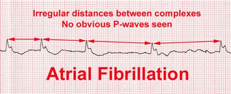 Clinical Ecg Ekg Interpretation Basics How To Read Mi Myocardial Infarction Angina