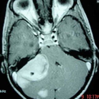 MRI T2WI lumbosacral spine showing disc desiccation at L4-5 causing ...