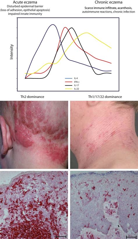 Immunology Of Atopic Eczema Overcoming The Th1 Th2 Paradigm Eyerich 2013 Allergy Wiley