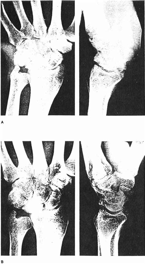 Malacia of the h a t e bone of an 18-year-old man. A. Preoperative.... | Download Scientific Diagram