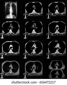 Computed Tomography Ct Scan Chest Abdomen Stock Photo