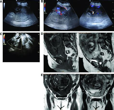 Placenta Accreta Transabdominal A Gray Scale B Color Doppler