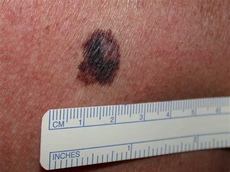 Figure Melanoma Dermnet New Zealand Statpearls Ncbi Bookshelf