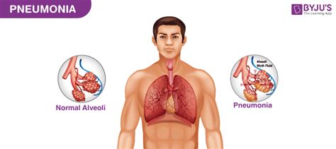 Pneumonia Types Causes Symptoms And Treatment