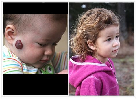 New York Hemangioma Treatment Los Angeles Vascular Malformation Care