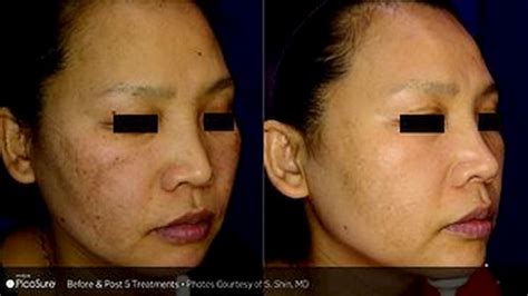 melasma-treatments-before-and-after-3 - Thin MD Med Spa