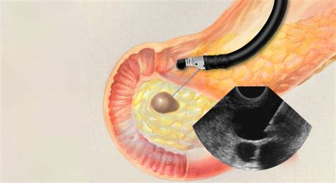 Accurate Endoscopic Ultrasound in Mumbai | Expert Gastroenterologists