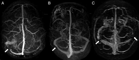 A New Index For The Assessment Of Transverse Sinus Stenosis For