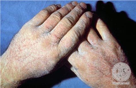 Occupational Risk Assessment And Irritant Contact Dermatitis Ann R Lurati 2015