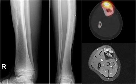 The Radiology Assistant Bone Tumor A G