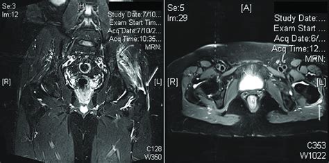 Preoperative Mri Which Allows For Characterization Of Abductor Tears Download Scientific