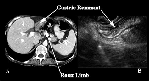 Eus Assisted Fluoroscopically Guided Gastrostomy Tube Placement In