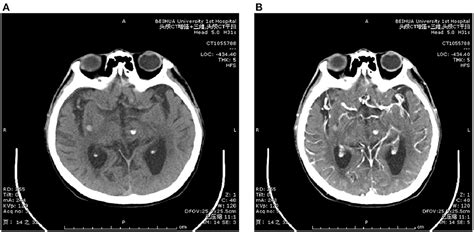 Frontiers Analysis Of Characteristics Of Intracranial Cavernous Angioma And Bleeding Factors