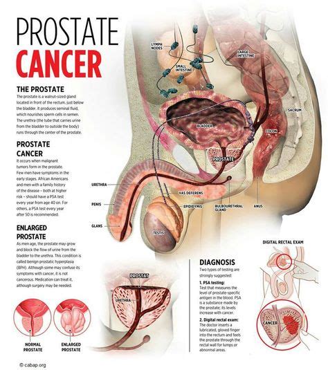 Cancer De Prostata Prostate Cancer