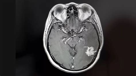 Glioblastoma Multiforme UniHealth Turkey