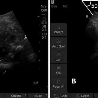 L5/S1 facet joint injection. A. EchoStim needle (arrowhead). B ...