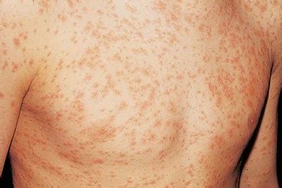 Hiv Rash Pictures Location Symptoms And Treatment