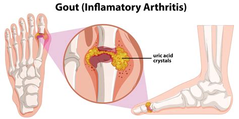 Gout Relief Treatments | Eugene Foot & Ankle