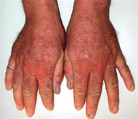 Figure From Enfermedad De Darier Y Acroqueratosis Verruciforme De