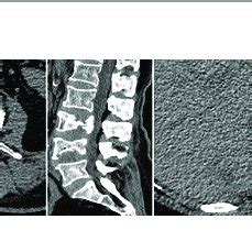 Primary Spinal Epithelioid Hemangioendothelioma Ehe In A