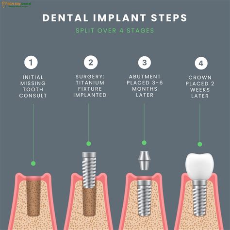 Dental Implant Placement Procedure: Get Your New Smile! | Dr. Cuong