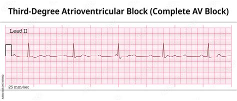 ECG Third Degree Atrioventricular Block - Complete AV Block - 8 Second ...