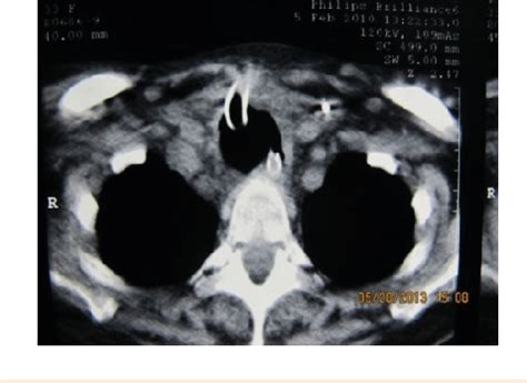 Figure 1 from Tracheoesophageal fistula - a complication of prolonged ...