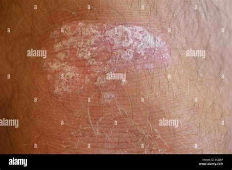 Tratamiento De La Psoriasis Fotografías E Imágenes De Alta Resolución Alamy