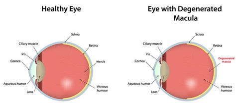 Macular Degeneration Sherman | Eye Examination Gainesville | RGB