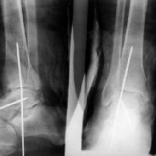 One Year Postoperative Radiographs Demonstrating Avascular Necrosis Of