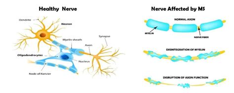 Multiple Sclerosis San Diego Biomedical Research Institutesan Diego Biomedical Research Institute