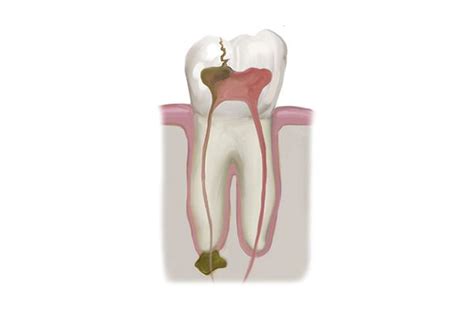 Root Canal Infection Symptoms - Virginia Beach, VA - The Smile Center