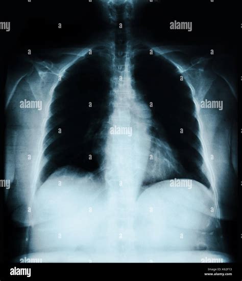 Tuberculosis lung x ray hi-res stock photography and images - Alamy