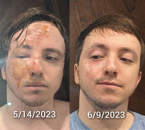 Beforeandafter Faceplanted In A Fire Pit About A Month Ago Wanted To