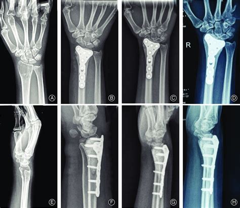 An Illustrative Case Of Giant Cell Tumor Of The Bone GCTB Of The